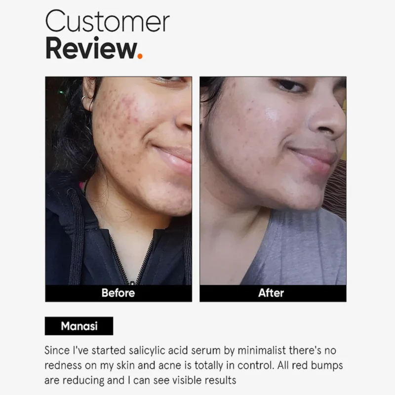 Buy Minimalist Salicylic Acid 2% Serum in Nepal for acne & oil control. 100% original with COD at Beautix Nepal. Fast nationwide delivery.