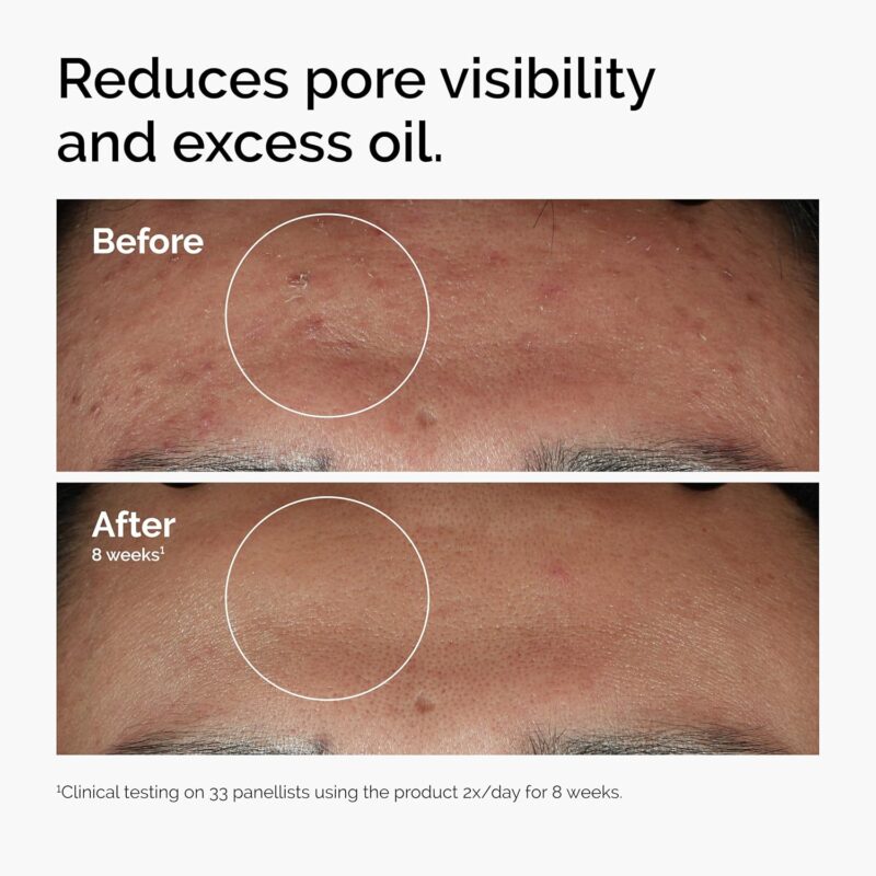 Buy The Ordinary Niacinamide 10% Zinc 1% in Nepal at Beautix Nepal. Control oil, reduce pores and blemishes with 100% authentic serum.