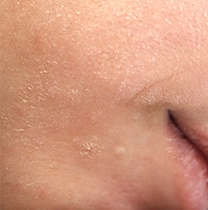 dry skin