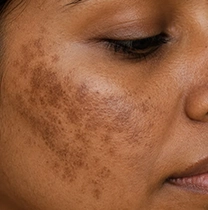 melasma skin