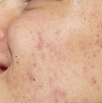 Pigmentation & Dark Spot